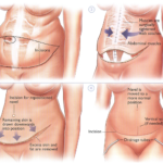 The popularity of cosmetic surgery and abdominoplasty